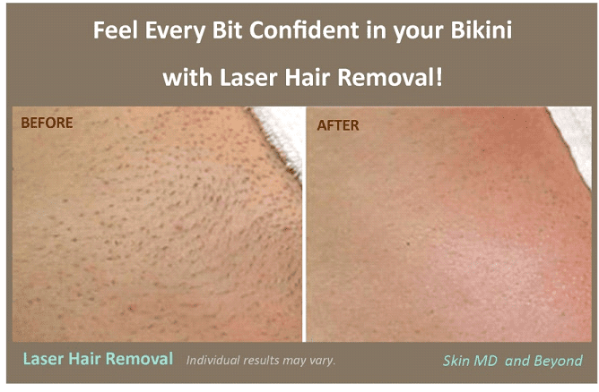 local laser hair removal laser hair removal bikini line ...