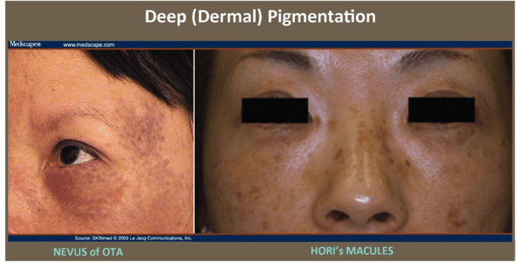 Pigmentation - Cosmetic Skin Care Specialist Plano, TX