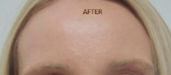 Patient # 72522 After Photo # 2