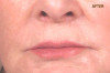 Patient # 95022 After Photo # 4