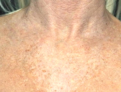 Patient # 59575 Before Photo # 1