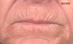 Patient # 37651 Before Photo # 1