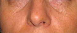 Patient # 74684 Before Photo # 1