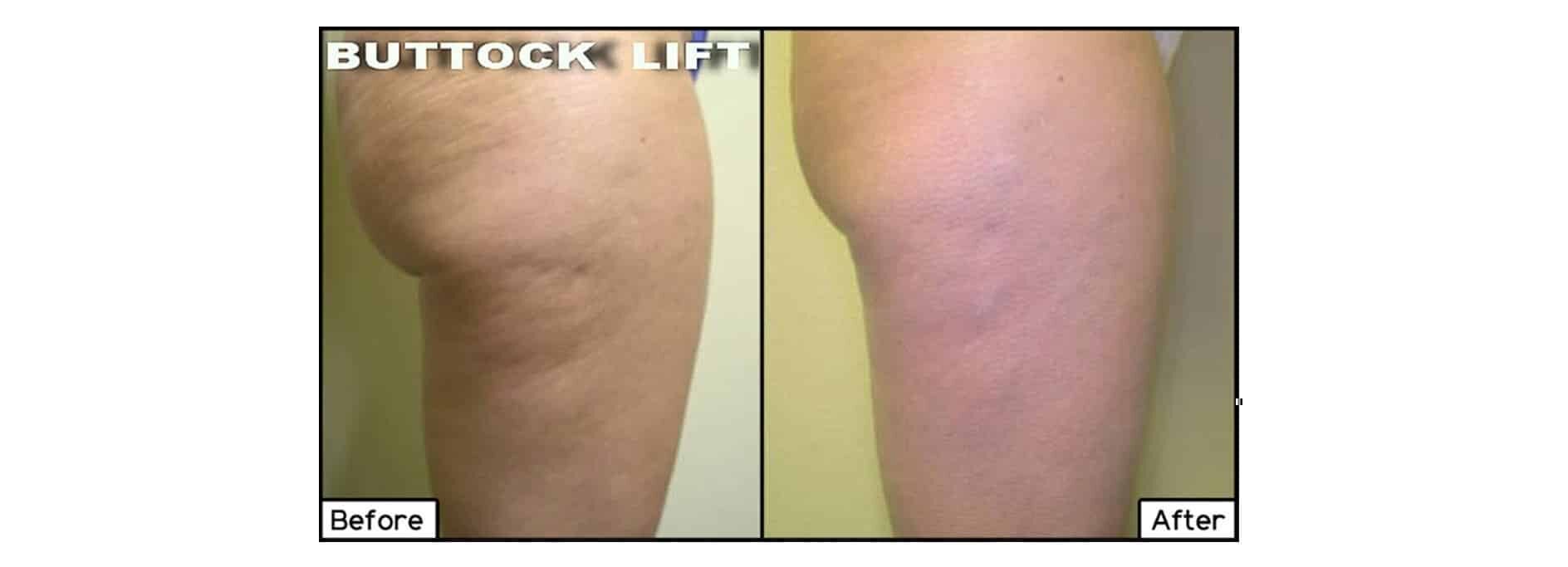 Advanced Cellulite Treatments in Plano & Frisco, TX