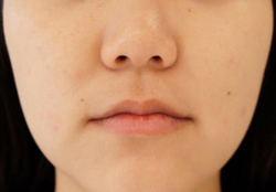 Patient # 87618 After Photo # 2