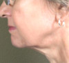 Patient # 13887 After Photo # 4