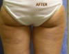 Patient # 94288 After Photo # 4