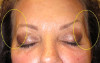Patient # 11681 Before Photo # 3