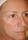 Patient # 48108 After Photo # 8