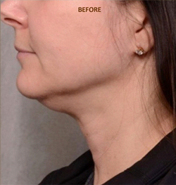 Patient # 98634 Before Photo # 1