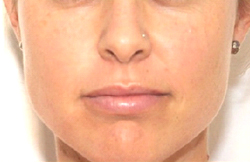 Patient # 84964 Before Photo # 1