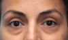 Patient # 75545 Before Photo # 3