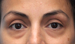 Patient # 75545 Before Photo # 1