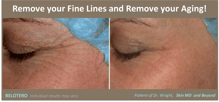 Before & After Belotero Plano TX