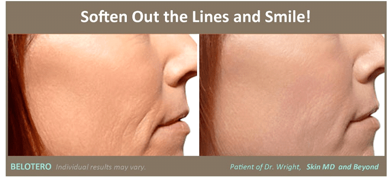 Before & After Fine Lines Plano TX