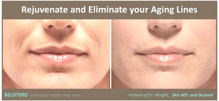 Belotero Treatment Frisco TX