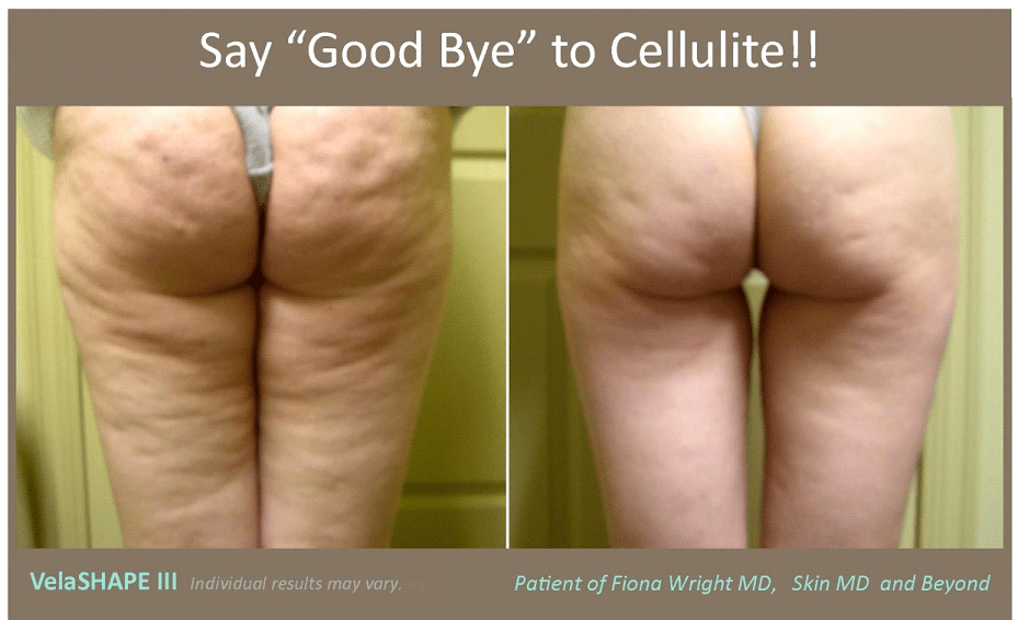 Cellulite Removal in Plano, TX