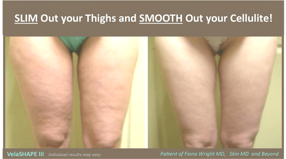 Body Contouring in Plano