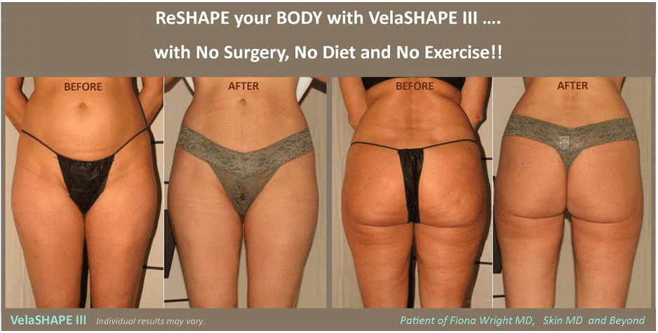 Velashape in Plano, TX