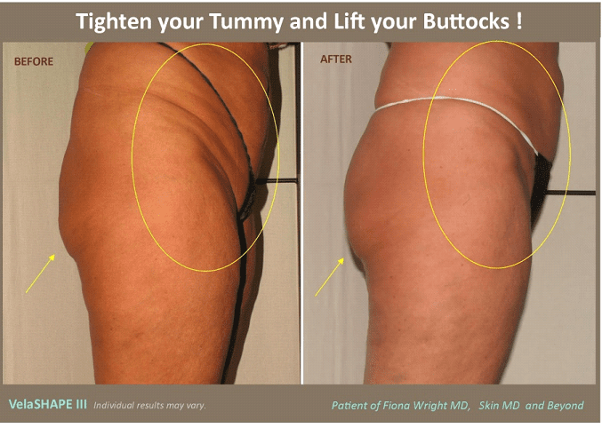 Tummy Tuck and Buttock Lift in Plano, TX
