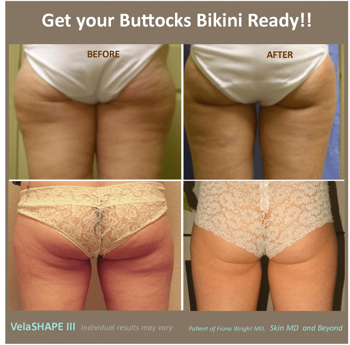 Buttocks VelaShape in Plano Texas
