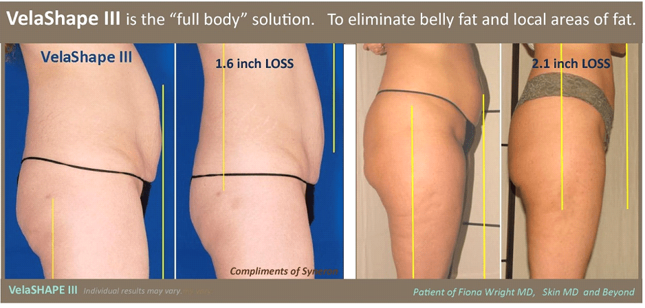 Full Body Velashape in Plano Texas