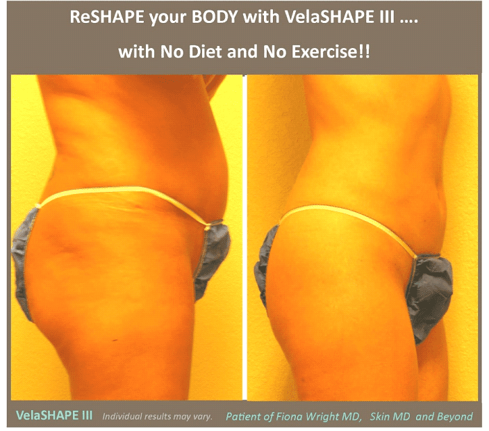 Body Contouring with Velashape in Texas