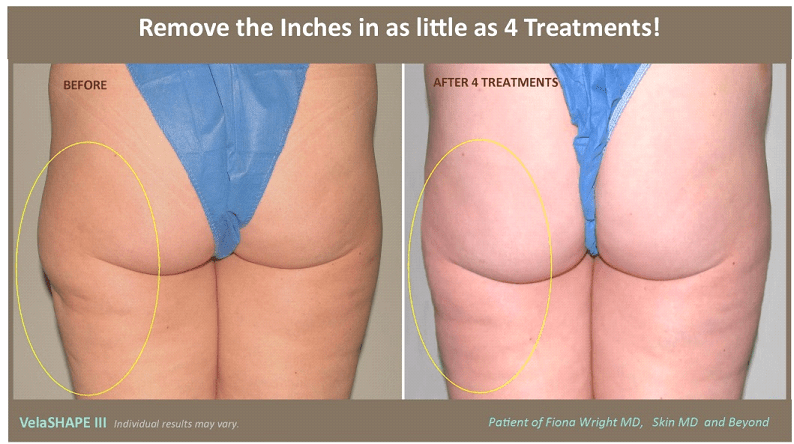 Buttocks Contouring in Texas