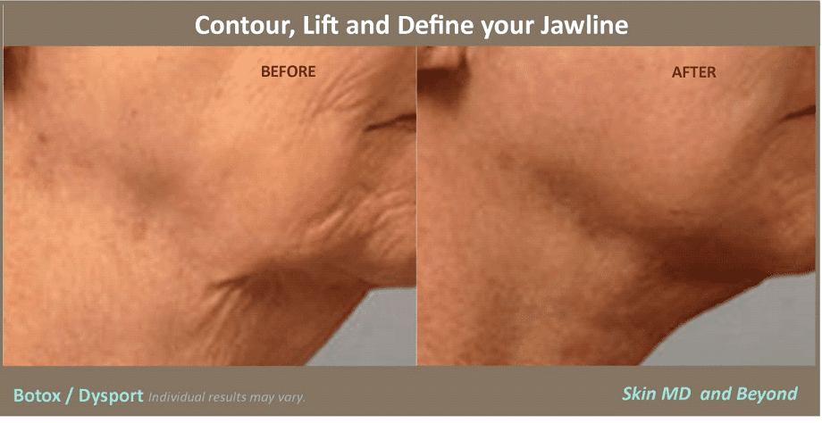 Before & After Botox Dysport Plano 