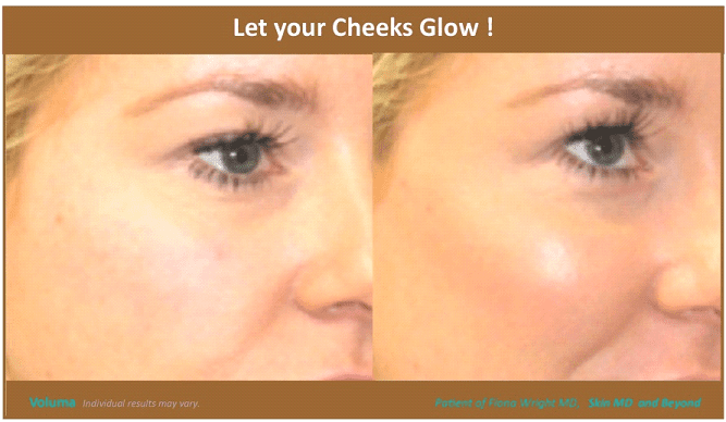 Before & After image of Cheek Lift Frisco TX
