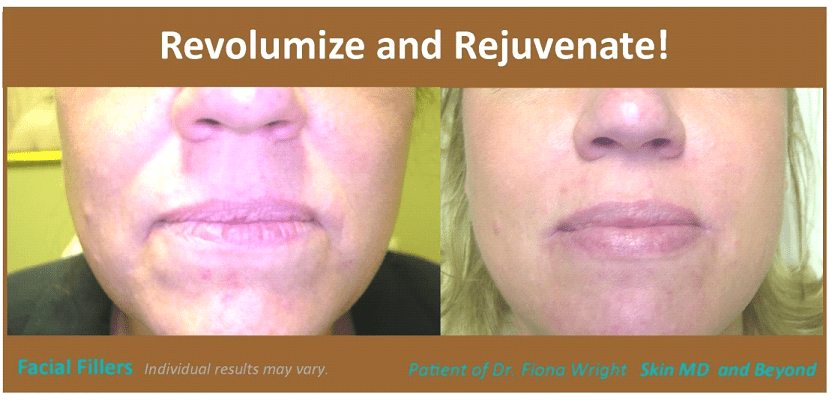 Before & After image of Voluma Cheek Lift Plano TX