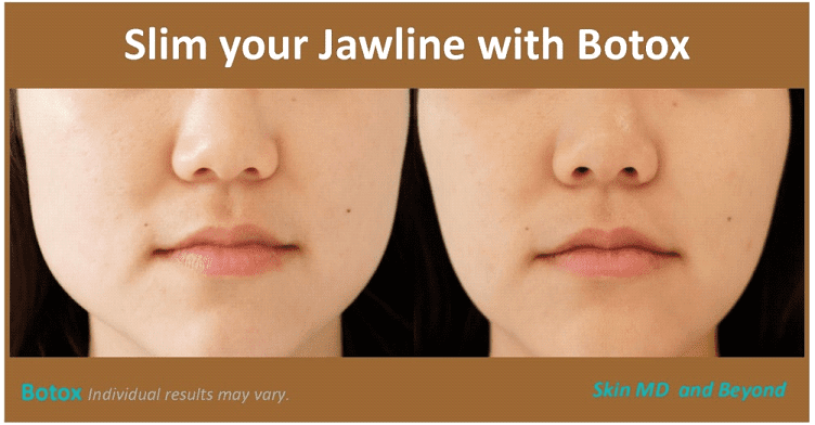 Before & After Cheek Rejuvenation Frisco TX