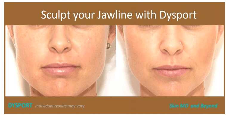 Before & After Jawline Dysport Plano