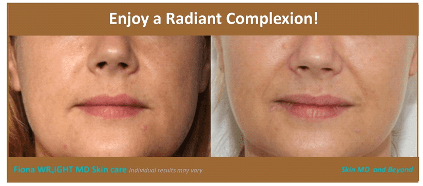 Before & After image of Microneedling Frisco TX