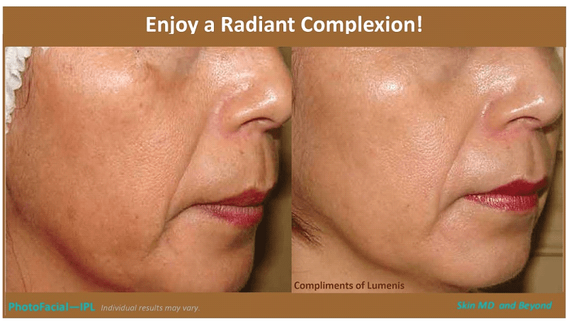 Before & After image of Facial Fillers Plano TX
