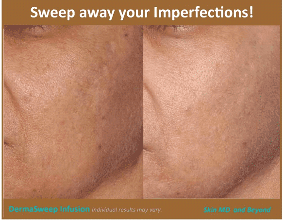 Before & After image of Cheek Fillers Plano TX
