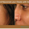 CHEEK REJUVENATION