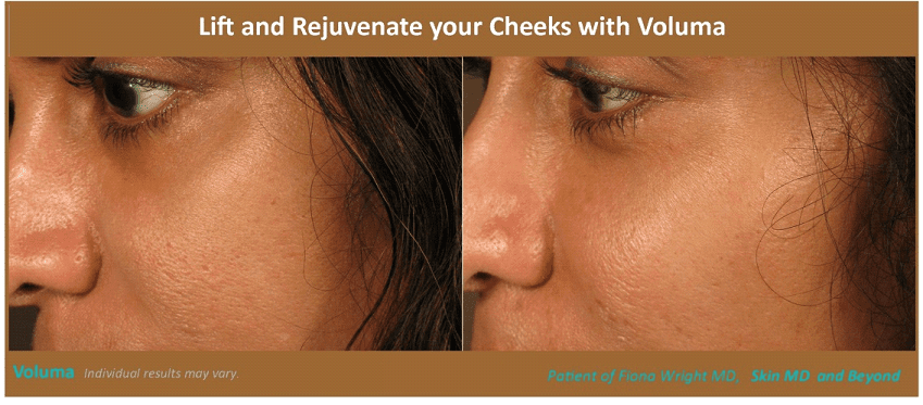Before & After image of Cheek Rejuvenation Plano TX