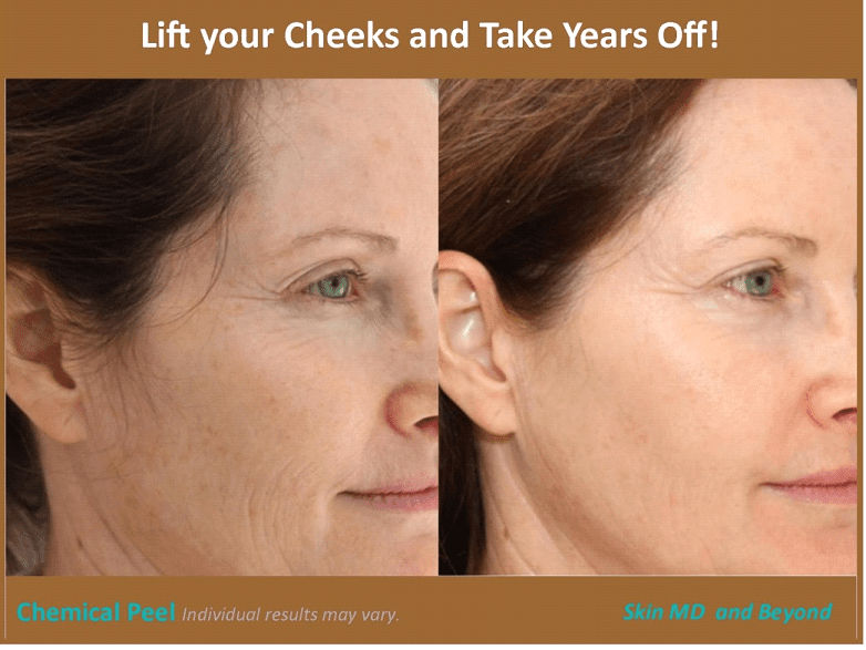 Before and after Facial Lines Frisco TX