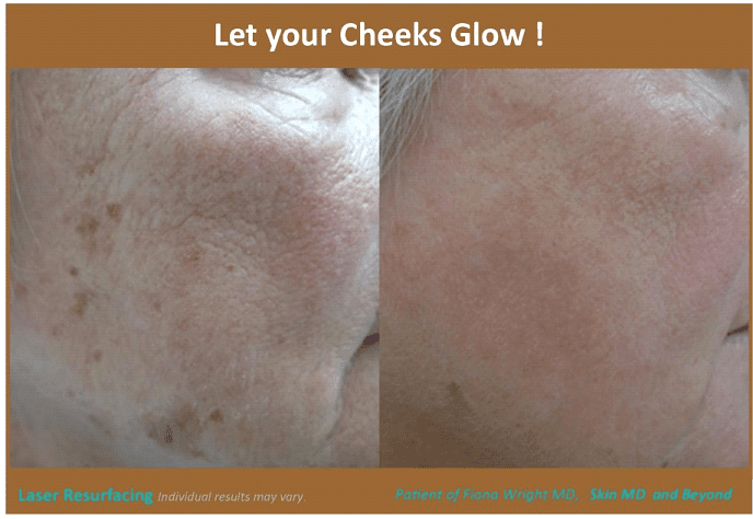 Before and after Facial Lines Treatment Frisco TX