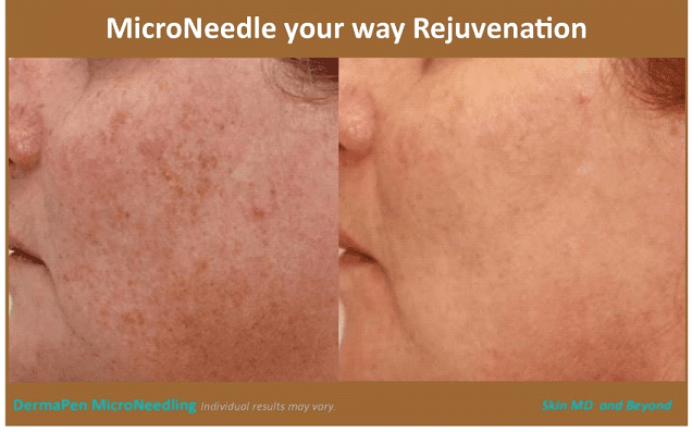 Before and after Facial Lines Treatment Plano TX