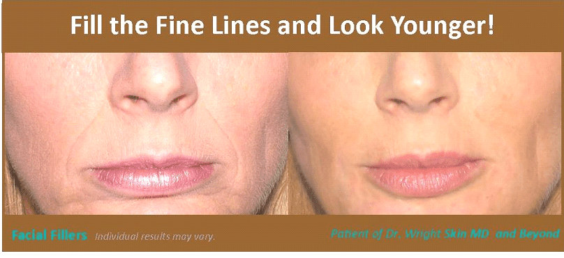 Before and after Wrinkle Treatments Plano TX