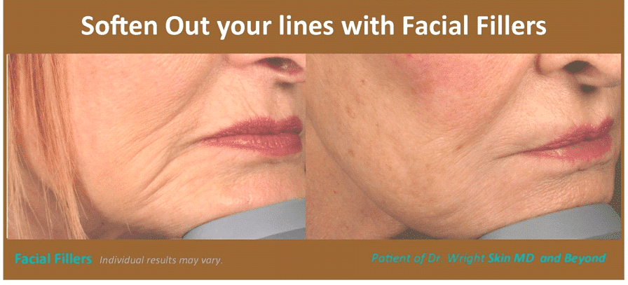 Before and after Wrinkle Treatments Frisco TX