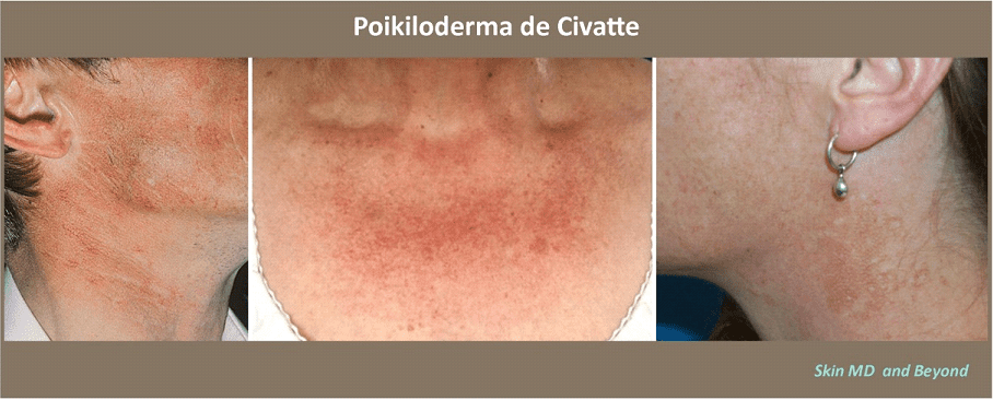 Before and After Image of Neck Rejuvenation Plano TX