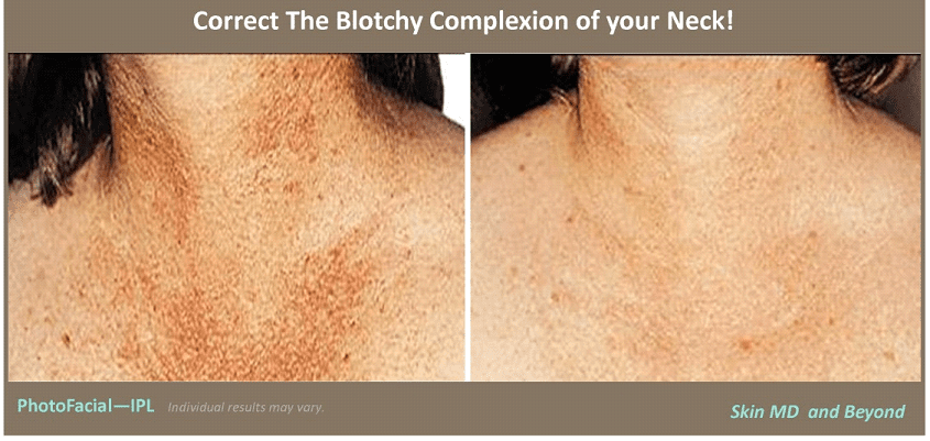 Before and After Image of Neck Rejuvenation Frisco TX