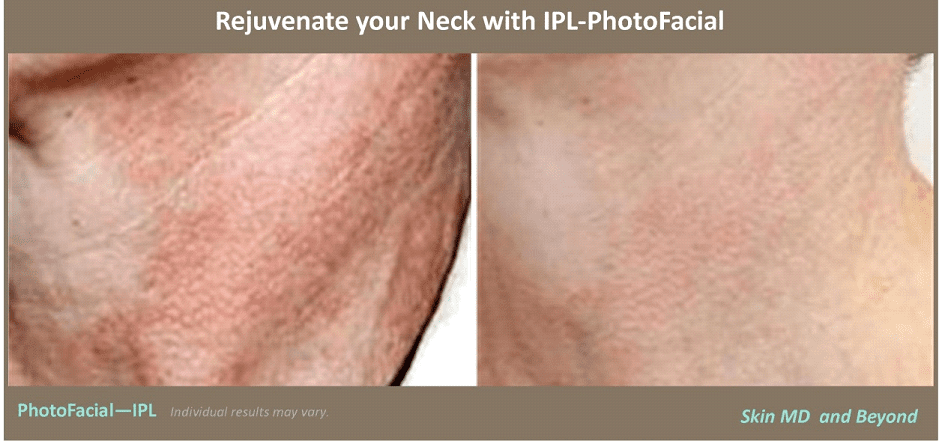 Before & After Image of Neck Rejuvenation IPL Photofacial Frisco TX
