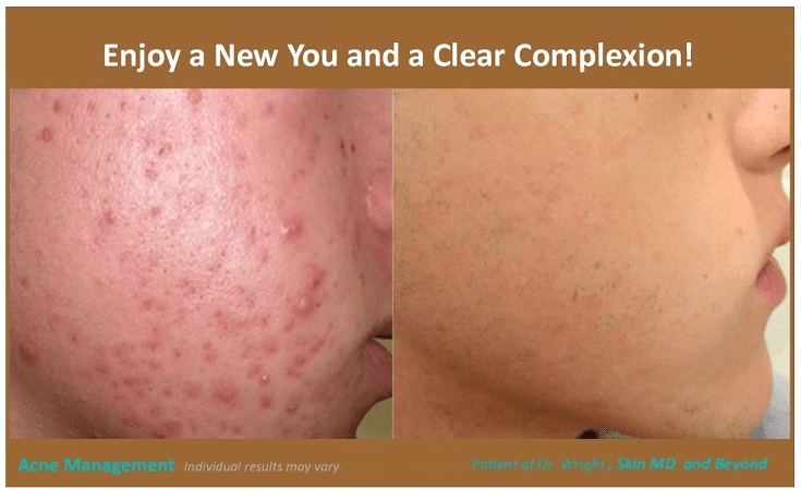 before and after acne treatment plano tx
