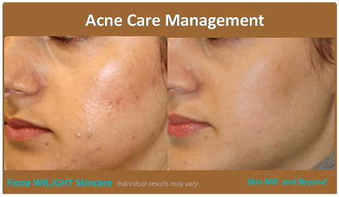 acne care plano tx