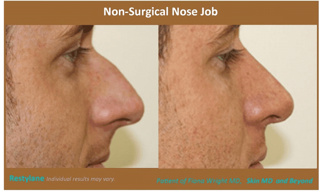 Before & After image of Nose Contouring Plano TX