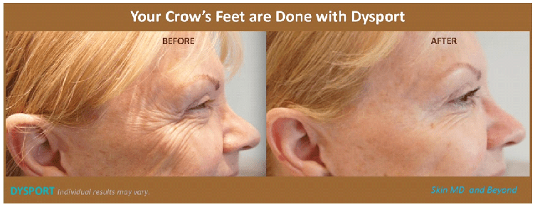 Crow’s Feet Treatment Plano TX